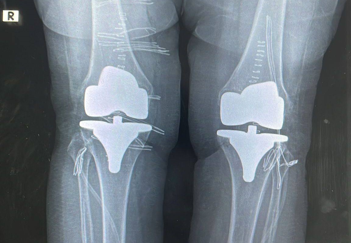 Çift taraflı diz proteziyle 73 yaşındaki hastanın ağrıları giderildi