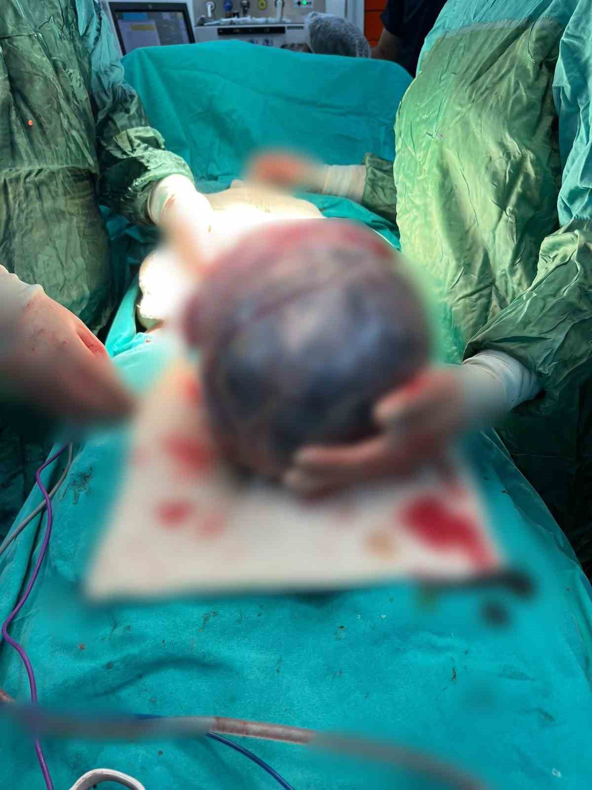 Operasyona alınan hastanın karnından &rsquo;dev t&uuml;m&ouml;r&rsquo; &ccedil;ıktı
