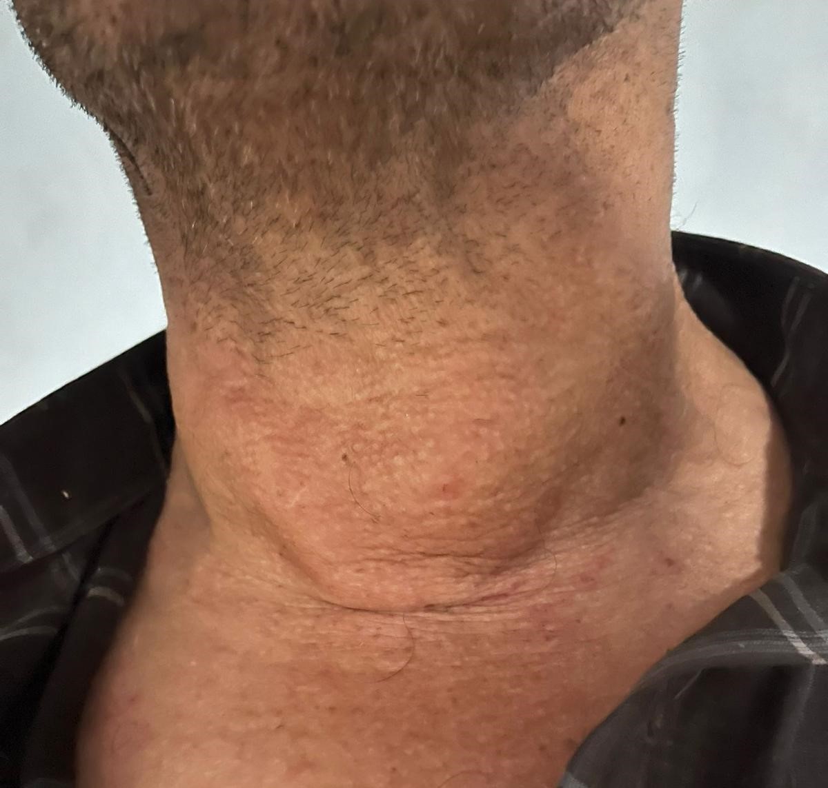 Kütahya’da dev guatr ameliyatsız tedavi edildi: Yüzde 90’dan fazla küçülme oldu