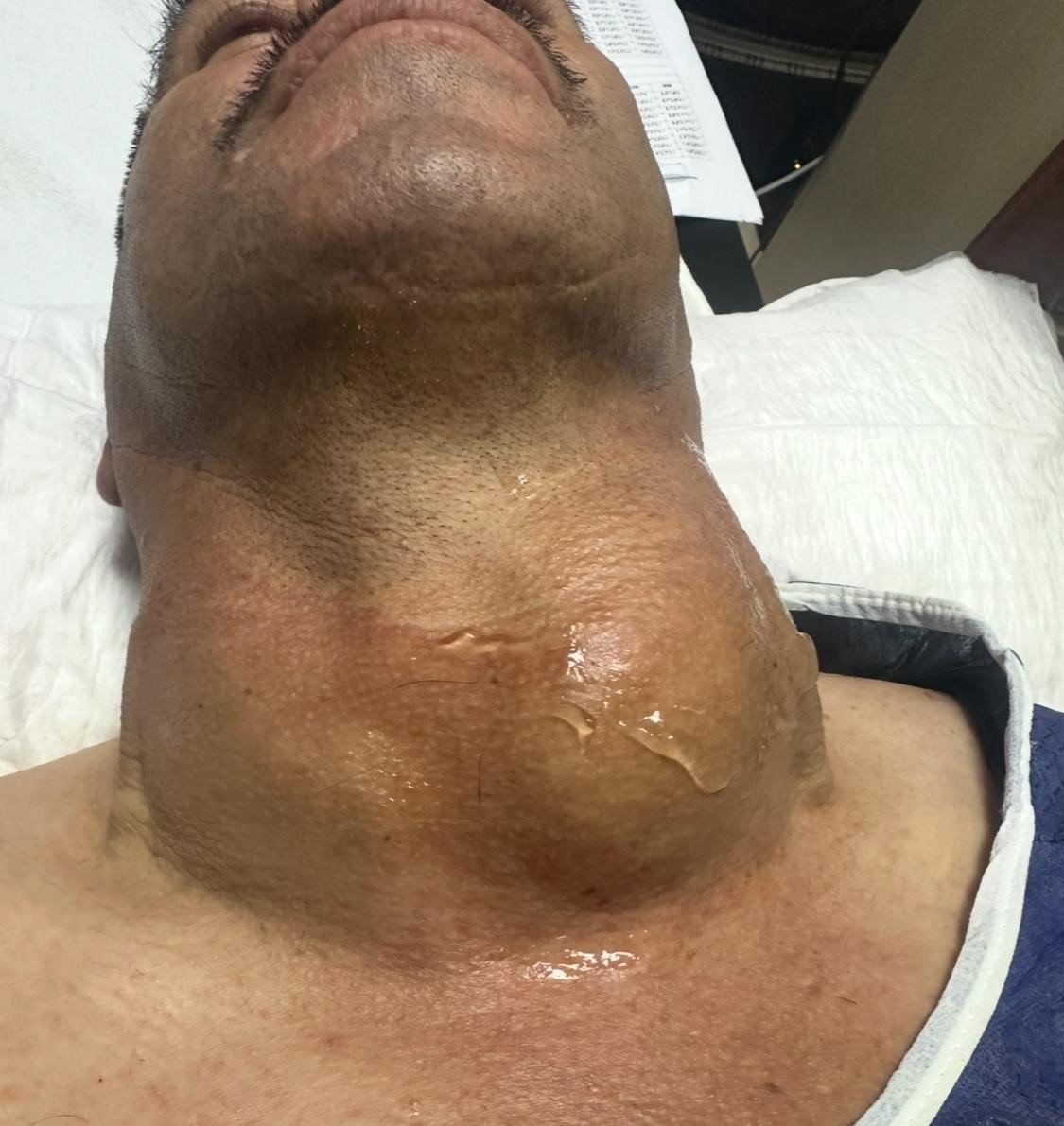 K&uuml;tahya&rsquo;da dev guatr ameliyatsız tedavi edildi: Y&uuml;zde 90&rsquo;dan fazla k&uuml;&ccedil;&uuml;lme oldu
