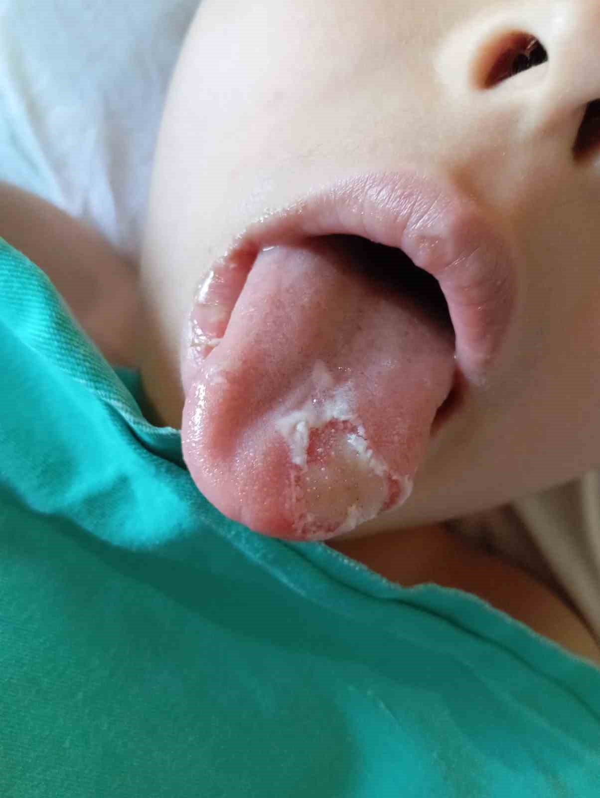 Nevşehir&rsquo;de 5 yaşındaki &ccedil;ocuğun ameliyatta dili ve dudağı yandı
