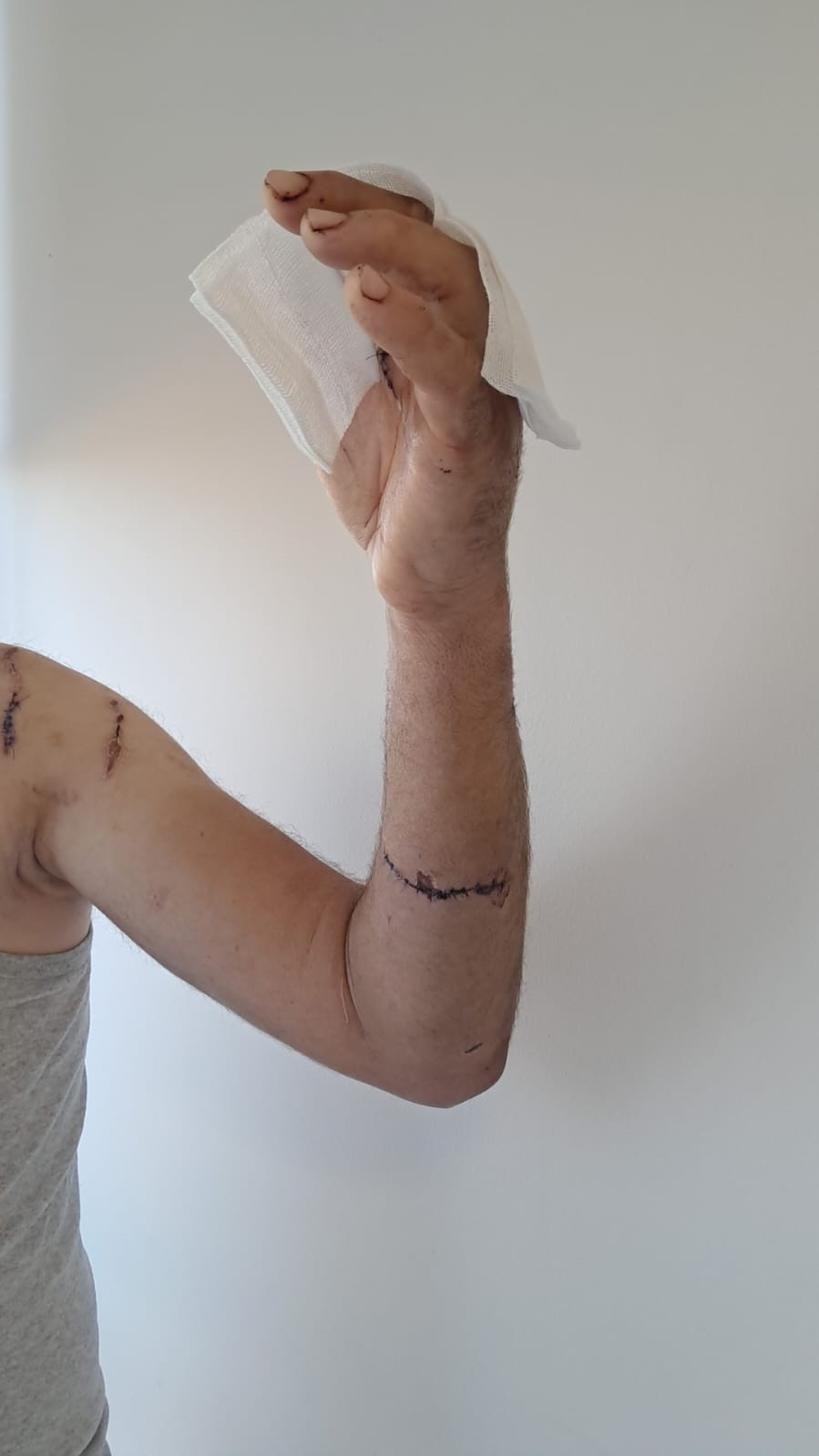 Ayının saldırısına uğrayan çiftçi dehşet anlarını anlattı: "Parmağımı kopardı"
