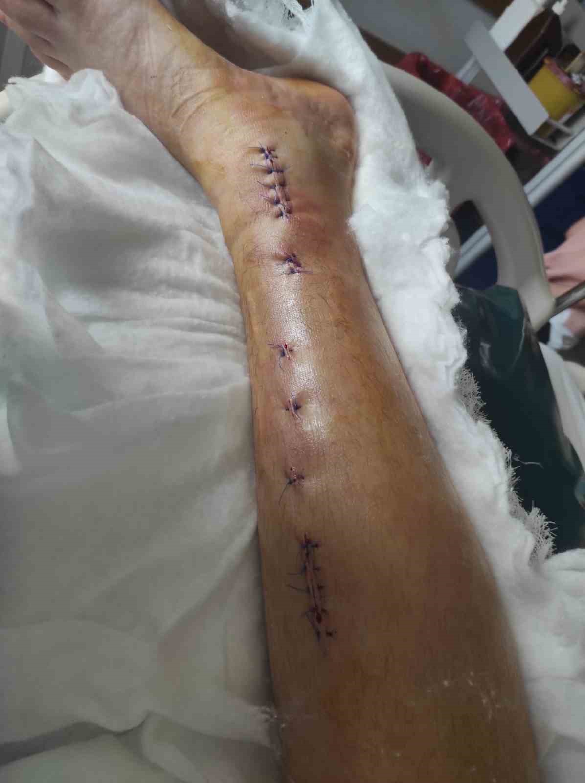 &Ouml;zel okulda &rsquo;akran şiddeti&rsquo; iddiası: &Ouml;ğrencinin ayağı kırıldı
