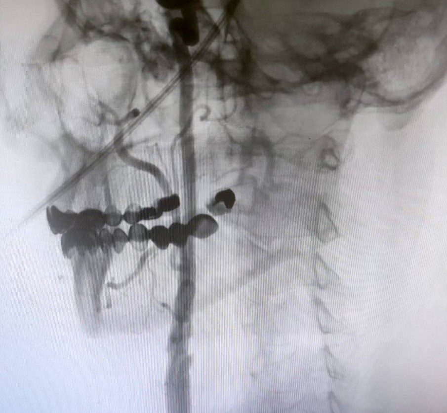 Manisa Şehir Hastanesi’nde felç riskine karşı ameliyatsız çözüm
