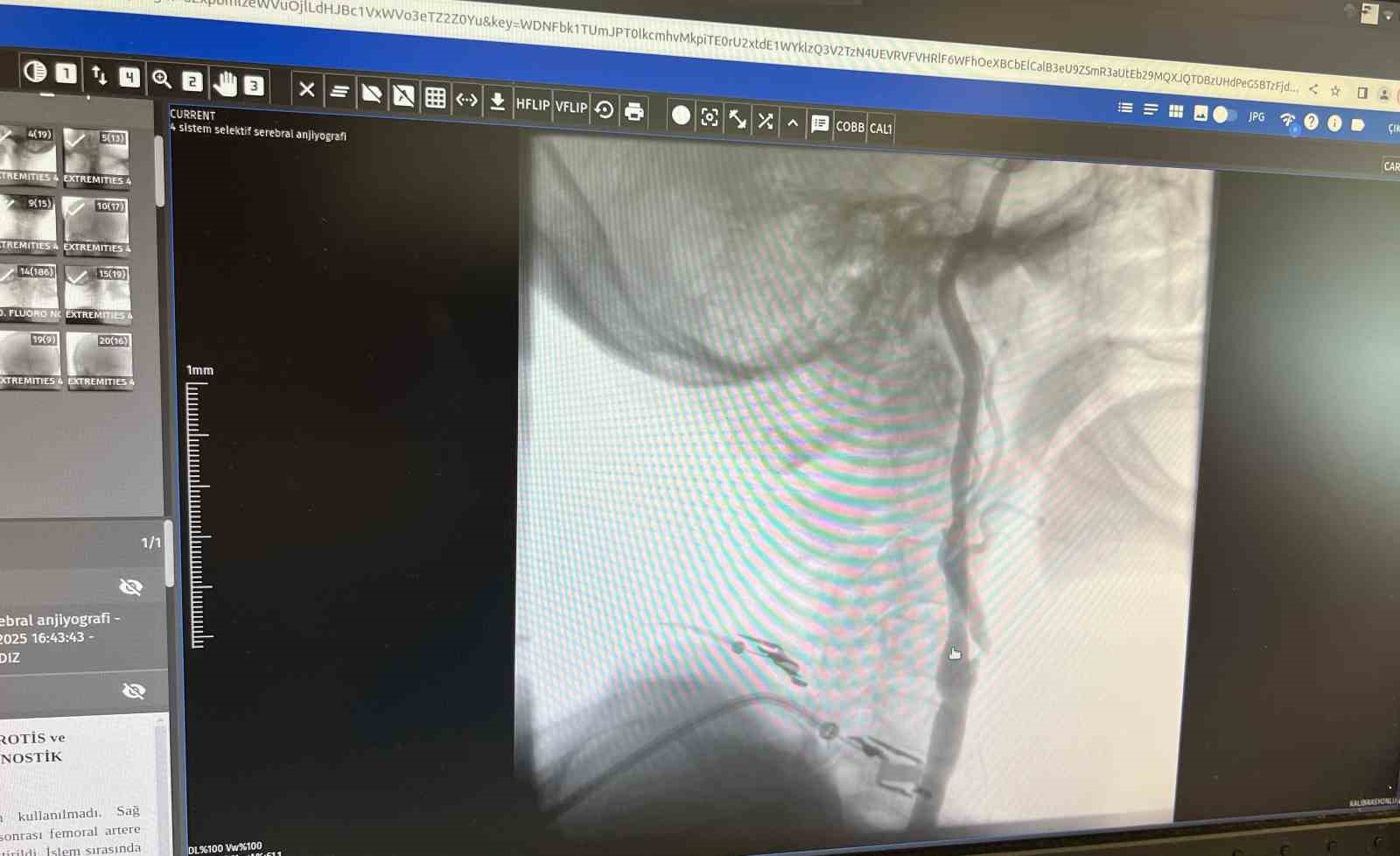 Manisa Şehir Hastanesi&rsquo;nde fel&ccedil; riskine karşı ameliyatsız &ccedil;&ouml;z&uuml;m
