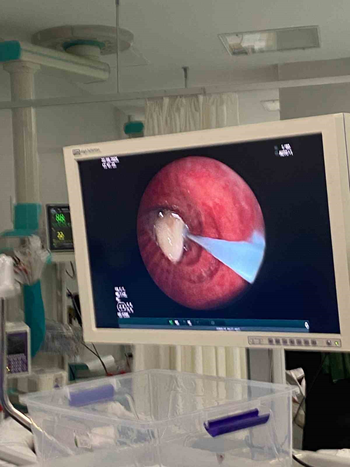 Yaşlı adamın akciğerine ka&ccedil;an sarımsak operasyonla &ccedil;ıkarıldı
