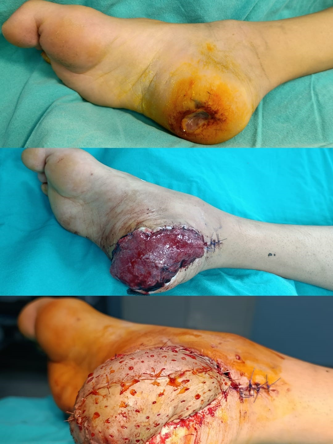 Kapanmayan yaraya Şırnak’ta serbest doku transferi