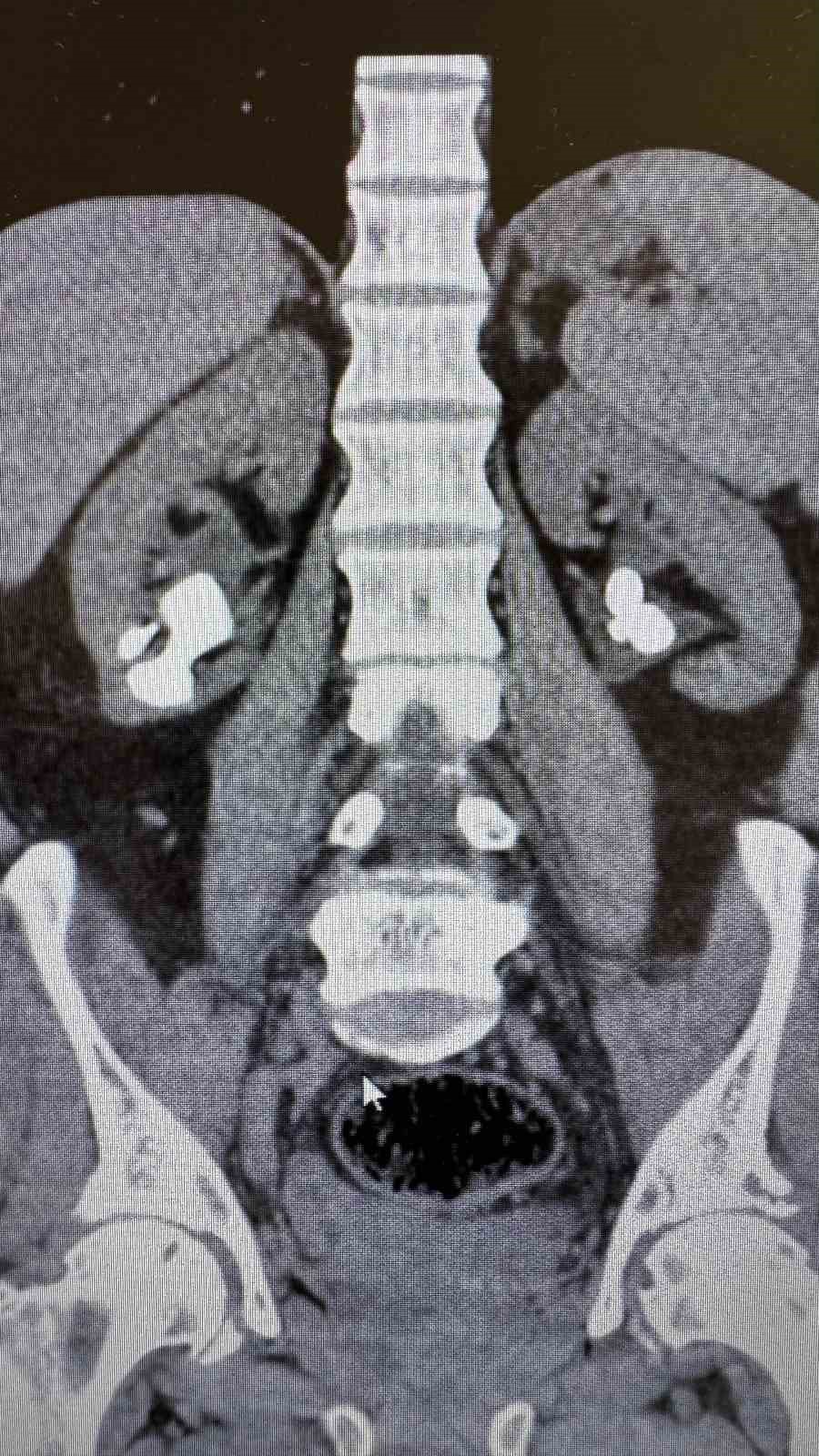 Gazipaşa&lsquo;da iki başarılı ameliyatla hasta b&ouml;brek taşlarından kurtuldu
