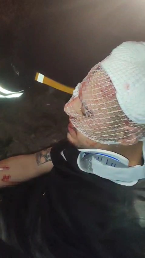 Motosiklet seyir halindeki tıra &ccedil;arptı: 2 yaralı
