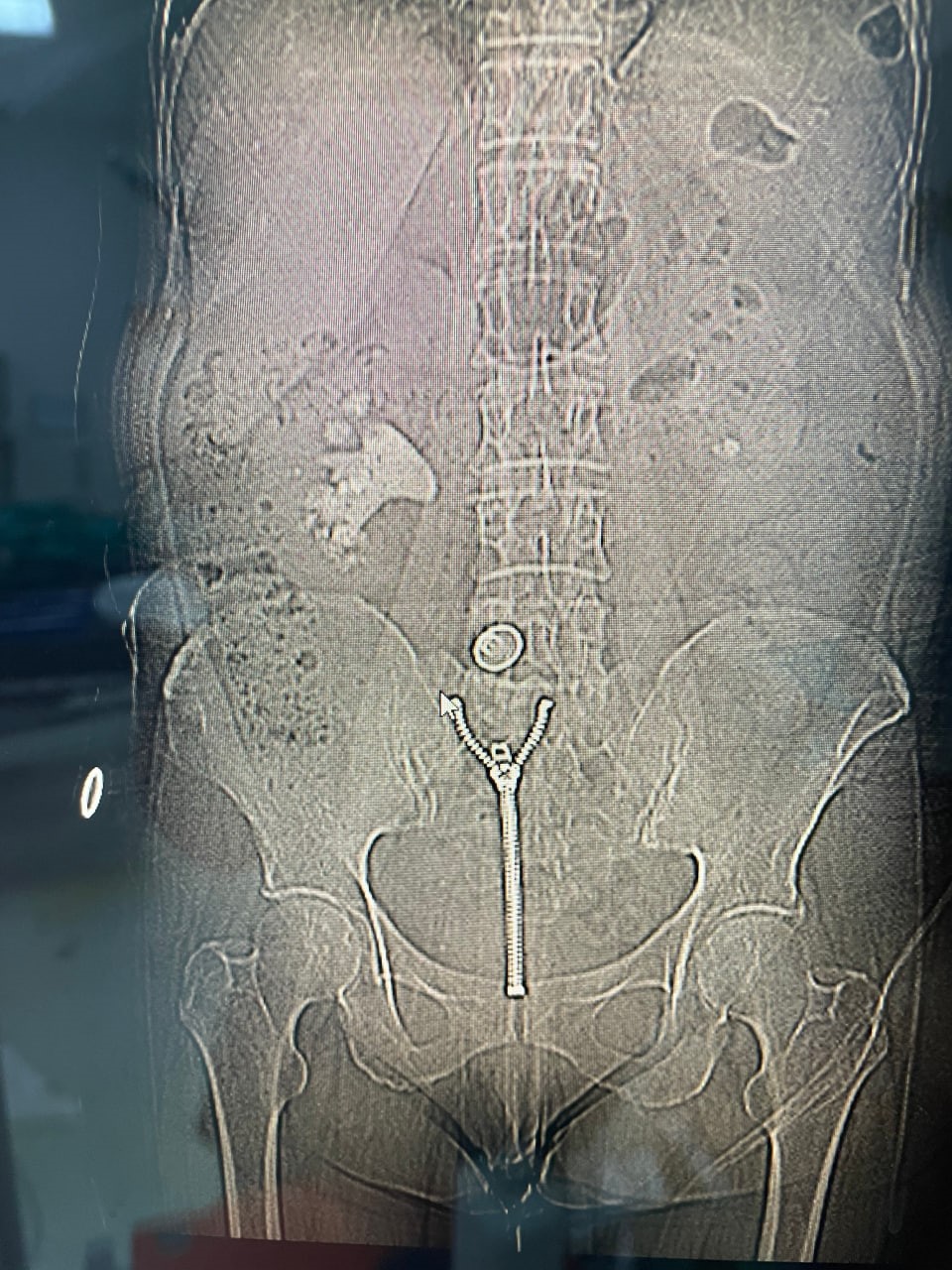 8 santimetrelik &rsquo;geyik boynuzu&rsquo; b&ouml;brek taşı kapalı y&ouml;ntemle &ccedil;ıkarıldı
