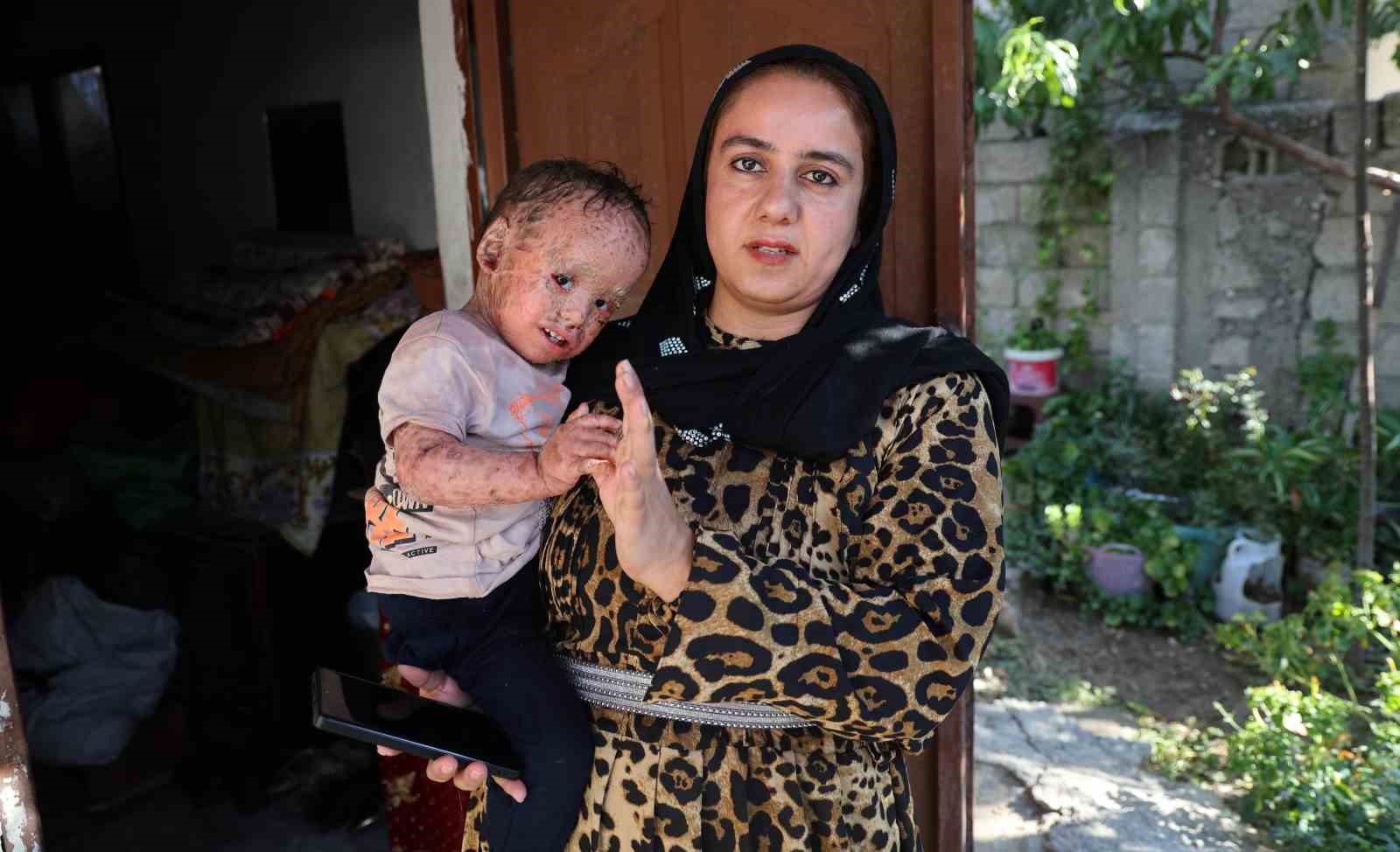 Balık pulu ve kelebek hastası Yusuf’un yardım paralarını dolandırıcılar topladı