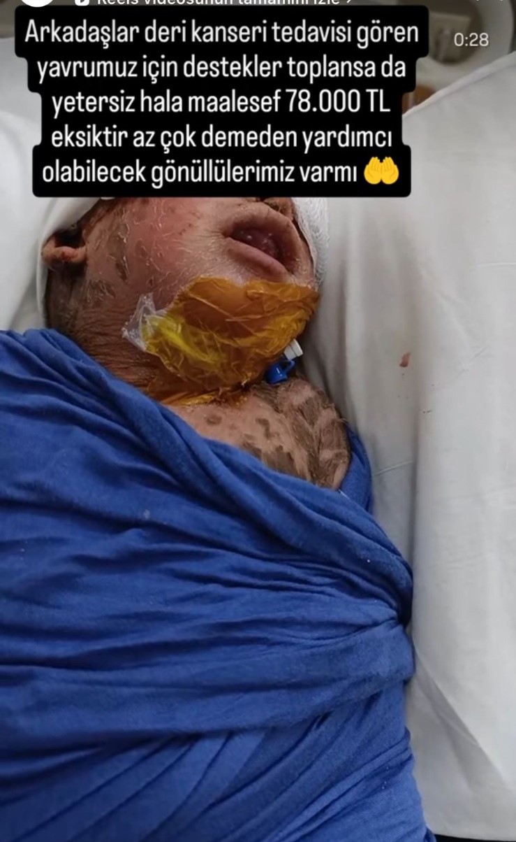 Balık pulu ve kelebek hastası Yusuf&rsquo;un yardım paralarını dolandırıcılar topladı
