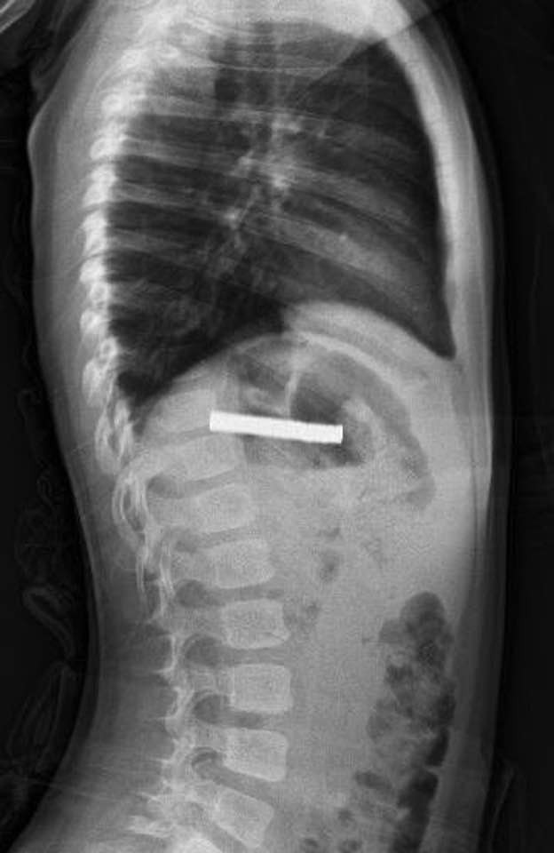 Çocuğun boğazından 19 adet mıknatıs çıkartıldı