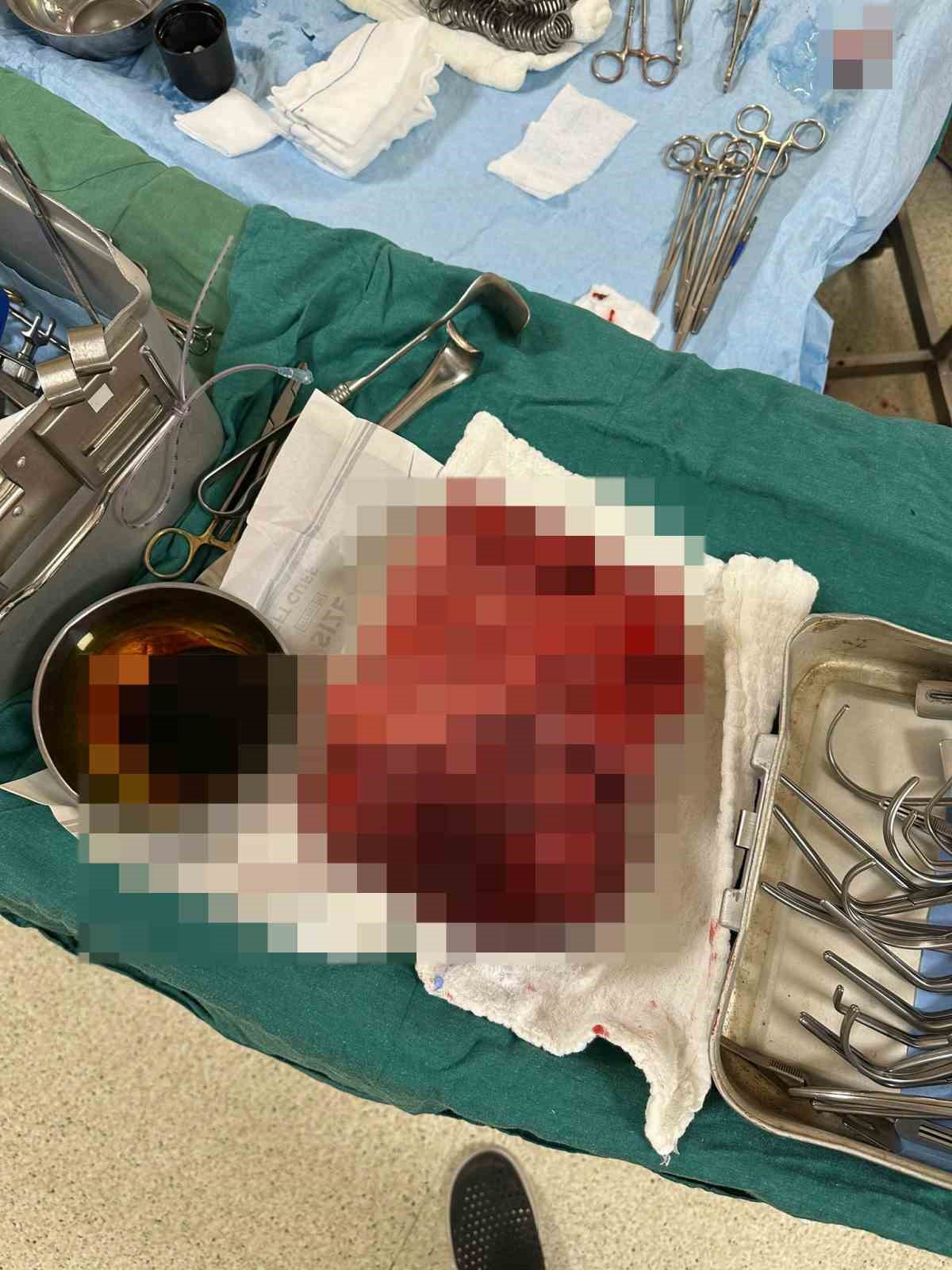 Nefes darlığı şikayeti ile hastaneye gitti, g&ouml;ğs&uuml;nden 3 kilogramlık t&uuml;m&ouml;r &ccedil;ıktı
