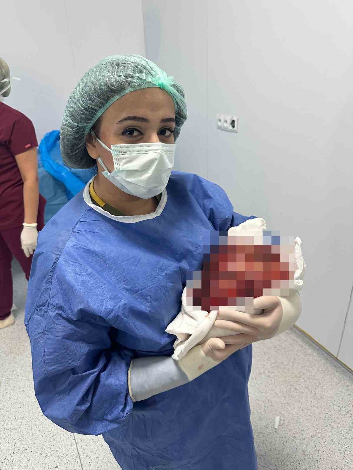 Nefes darlığı şikayetiyle hastaneye başvuran &ccedil;ift&ccedil;inin karnında 4 kiloluk kitle &ccedil;ıkarıldı
