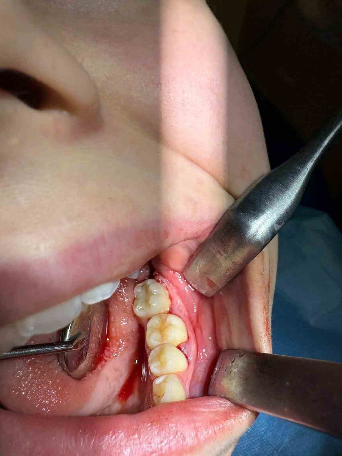 Karabük’te 16 yaşındaki hastaya doğal diş nakli yapıldı