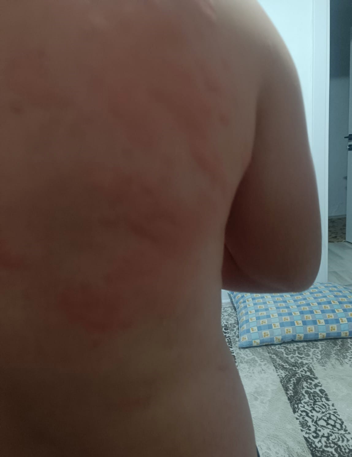 Elazığ’da böcek ısırığı hastanelik etti