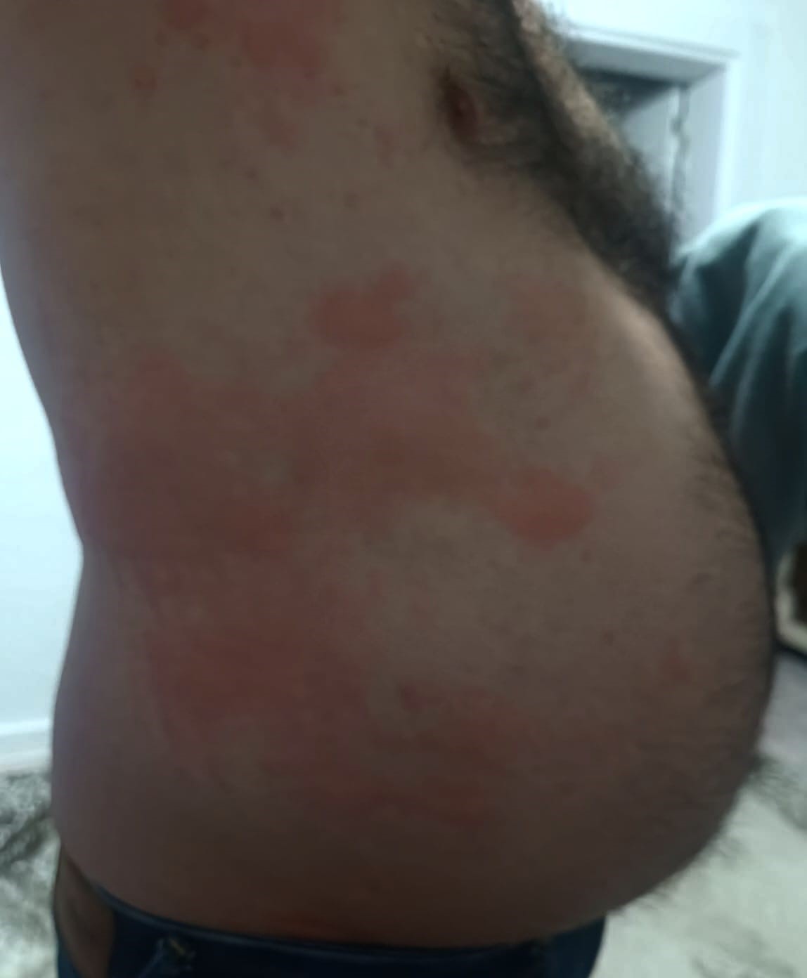 Elazığ’da böcek ısırığı hastanelik etti