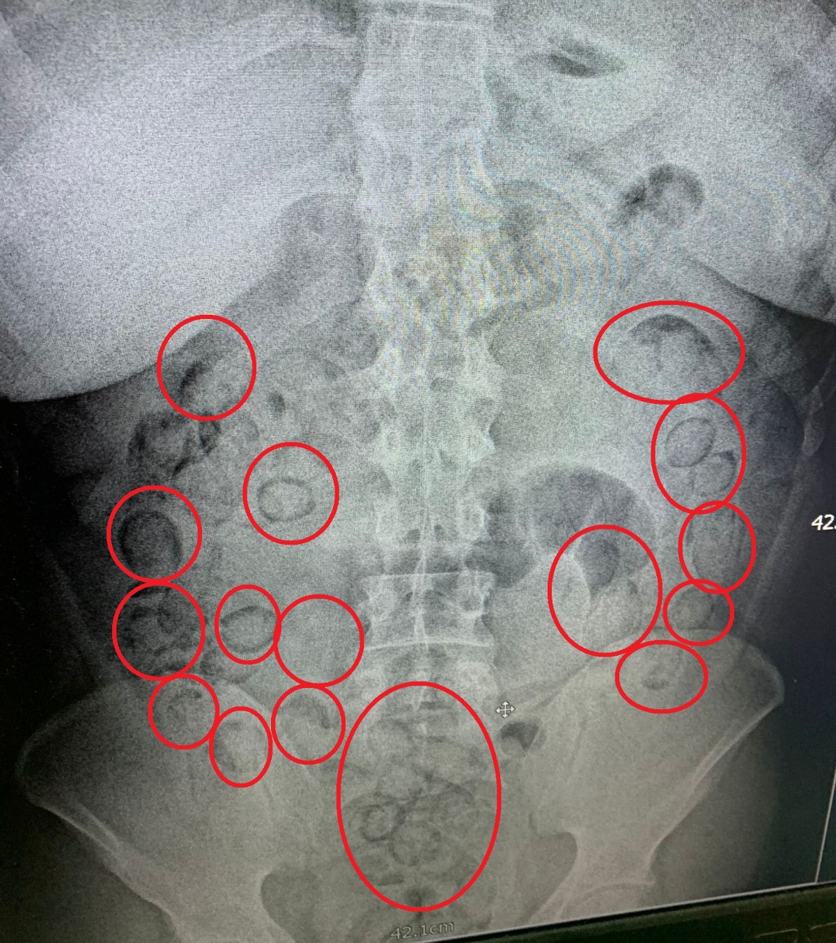 İranlı tacir, yutup midesine sakladığı 433 gram uyuşturucuyla yakalandı

