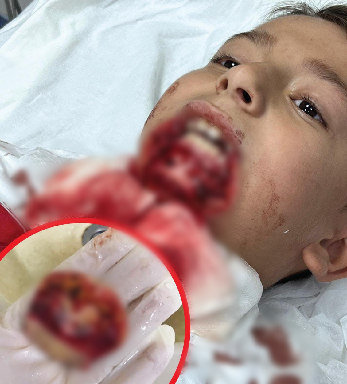 İlkokul öğrencisinin çenesi saplanan demir yüzünden koptu, ailesi okula ihmal davası açtı