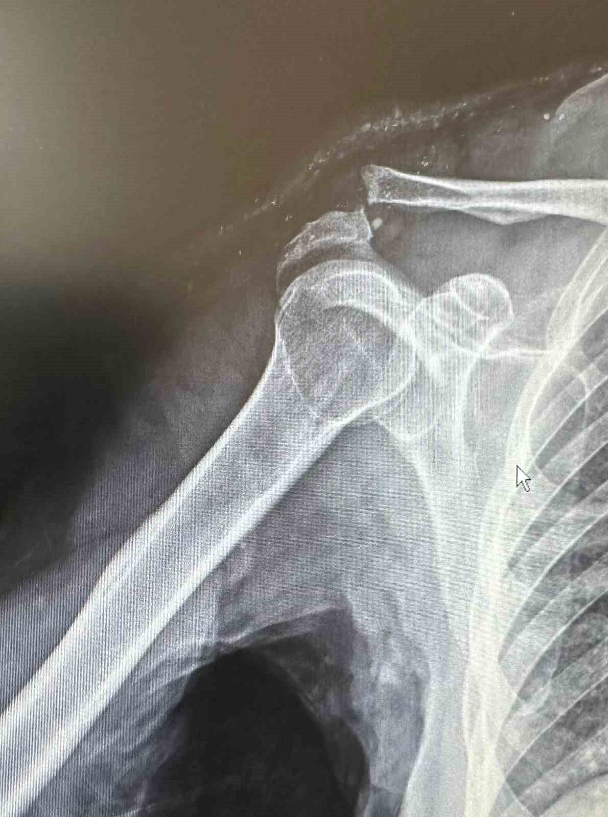 Tenis oynarken omuz &ccedil;ıkığı yaşayan 64 yaşındaki hasta, kullanılan &ouml;zel plakla sağlığına kavuştu
