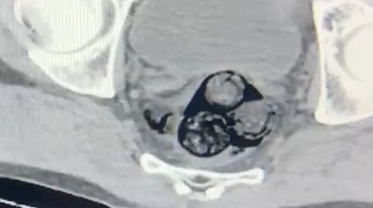 Iğdır’da uyuşturucu taşıyan yabancı uyruklu şahıs tutuklandı