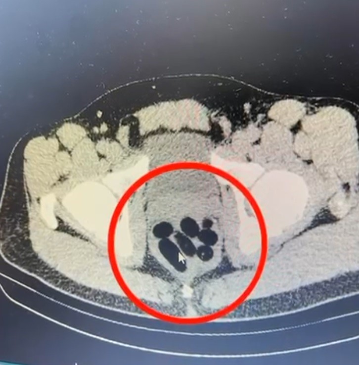 Uluslararası uyuşturucu madde ticareti yapan ş&uuml;pheli midesinde uyuşturucuyla yakalandı
