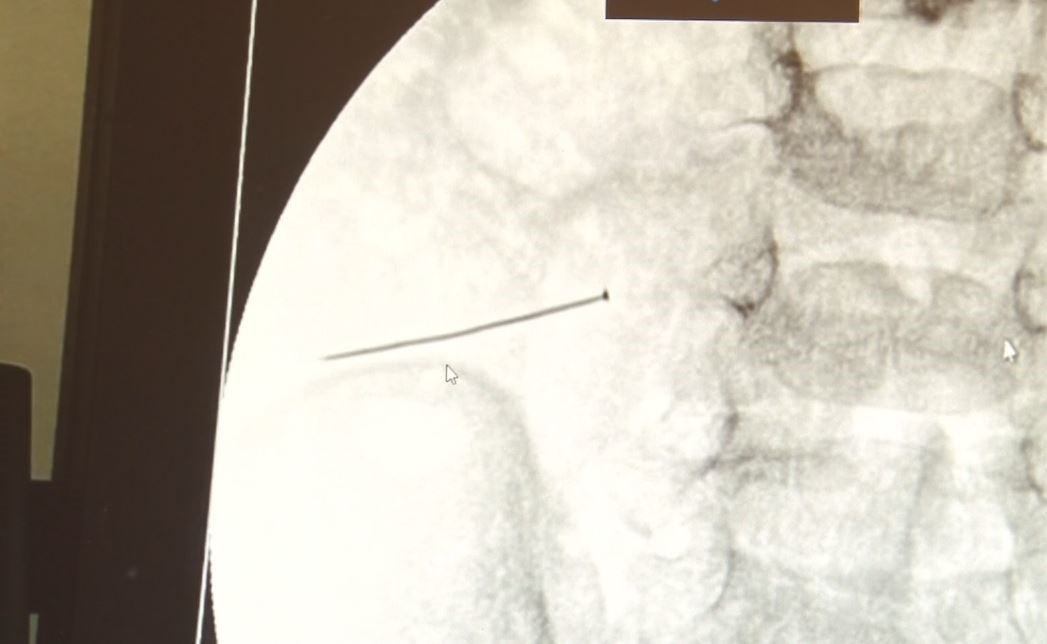 Ağrıyla kıvranan 2 yaşındaki çocuğun bağırsağından 3 santimlik iğne çıktı