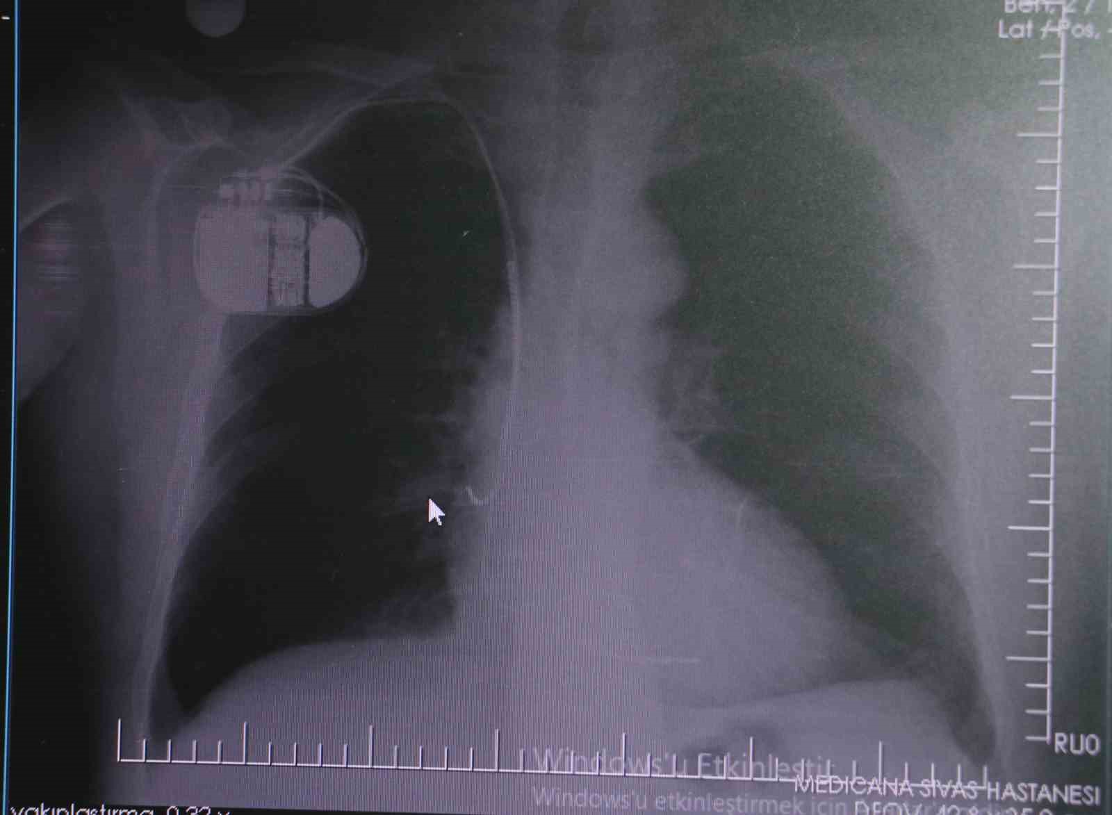 Uzmanından kalp pili taşıyanlara soğuk hava uyarısı: "Titreme cihazı yanıltabilir"
