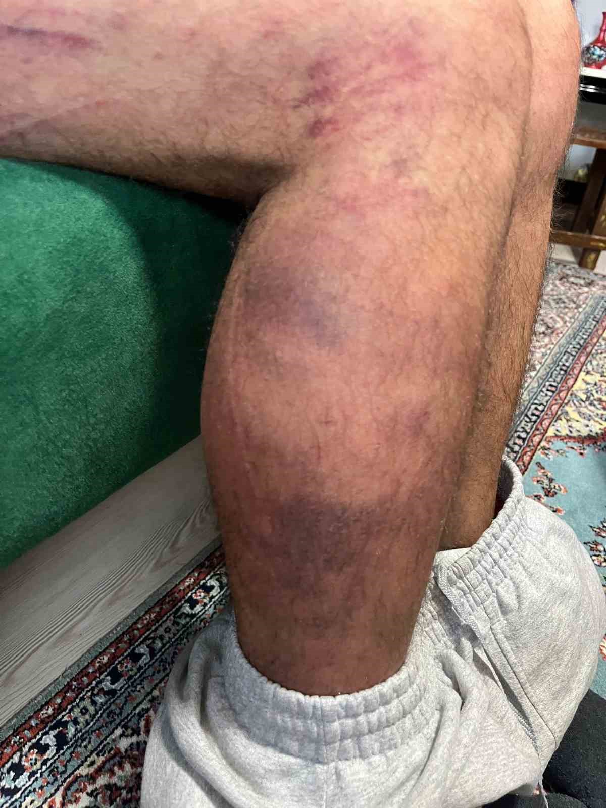 Vicdanları yaralayan olay: Otizmli şahıs odunluğa baktı diye odunla darbedildi