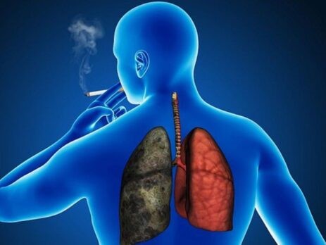 KOAH hastalarında 10 yıl içinde akciğer kanseri gelişme ihtimali yüksek
