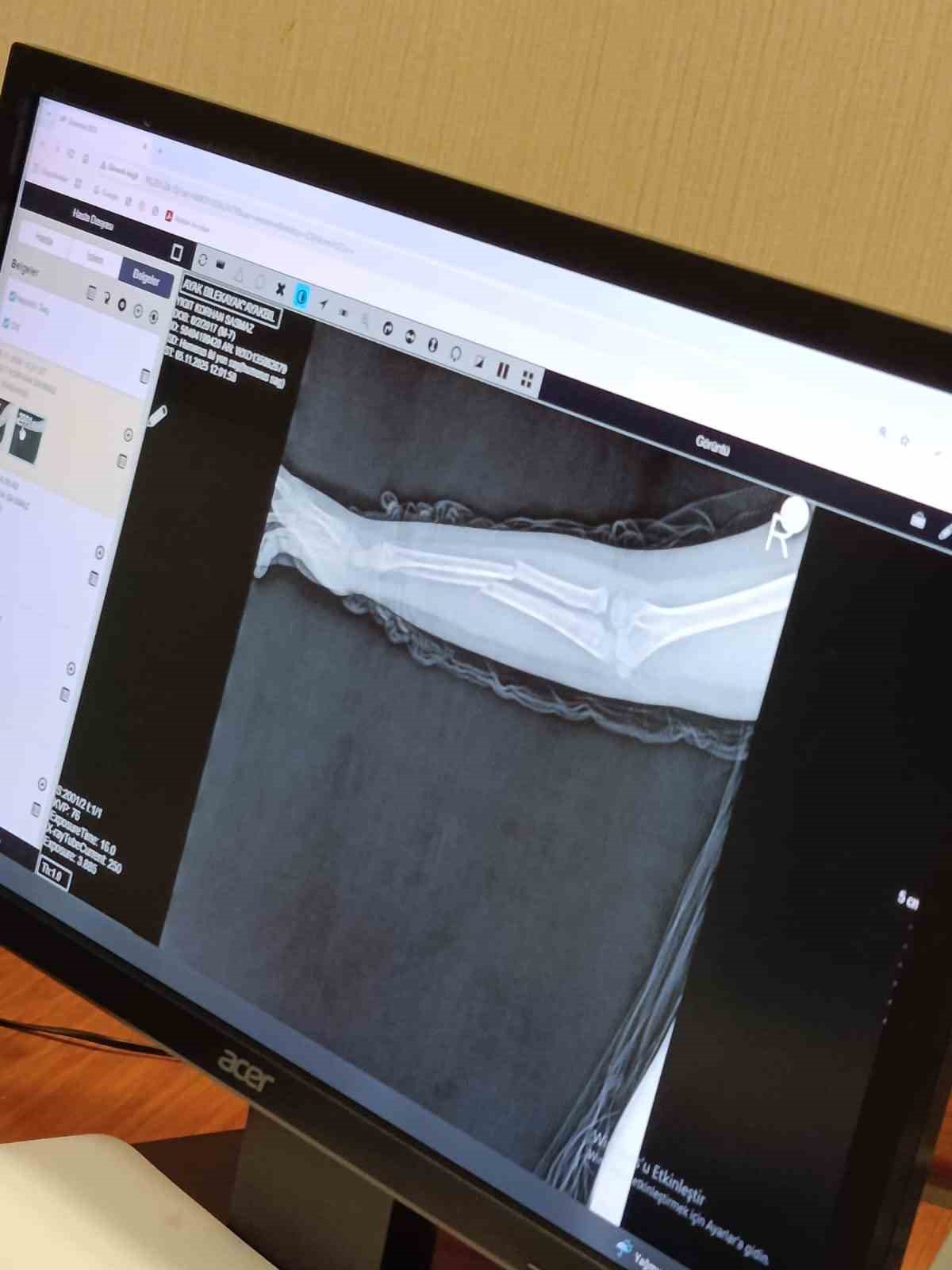 Büyükçekmece’de akran zorbalığı, arkadaşının kolunu 2 yerden kırdı
