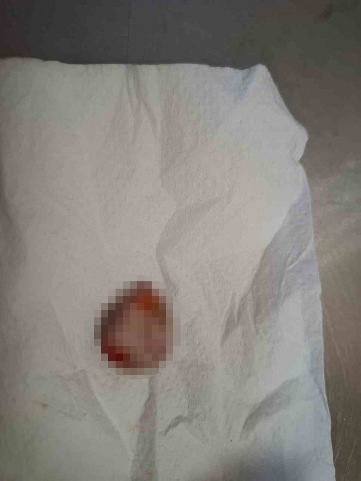 Kopan parmağını buz poşetine koyup yurt dışından Türkiye’ye geldi