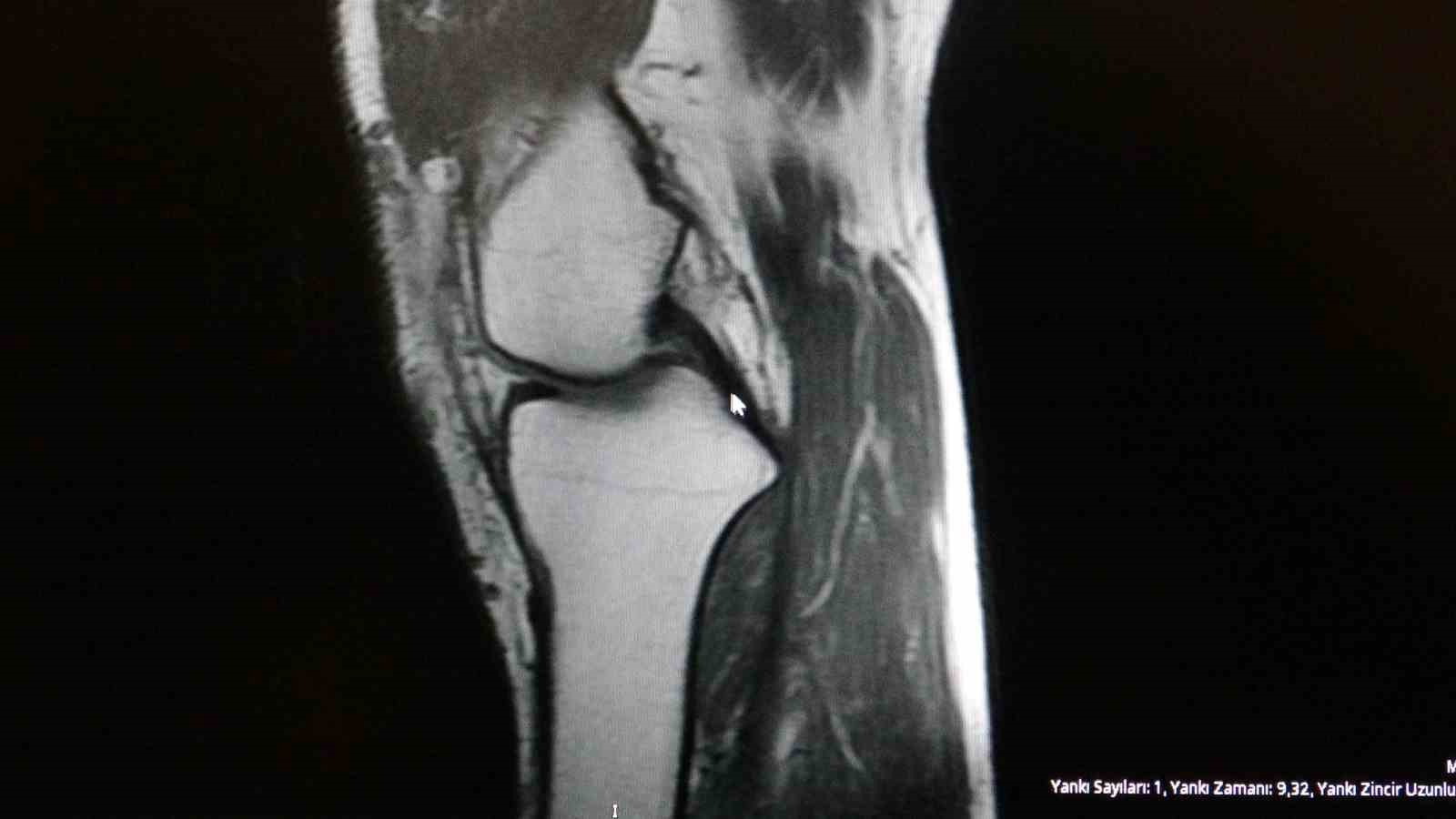 Ortopedi uzmanı tehlikeye karşı uyardı: "Herkes her sporu yapamaz"