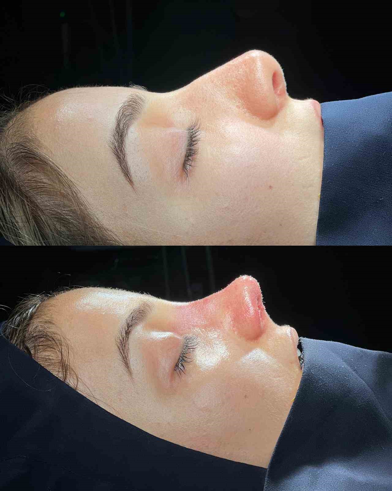 Cizre’de ilk defa yapılan revizyon rinoplasti ameliyatı gerçekleştirildi