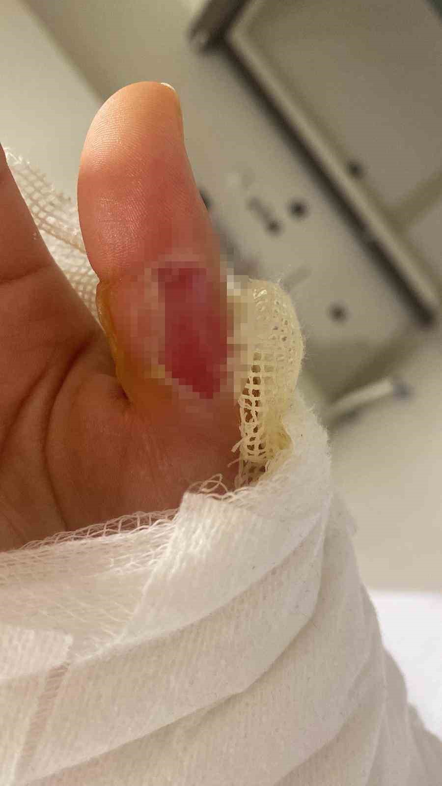 Sıcak su torbası patladı, gen&ccedil; kızın v&uuml;cudunun y&uuml;zde 25&rsquo;i yandı: "O acının tarifi yok"
