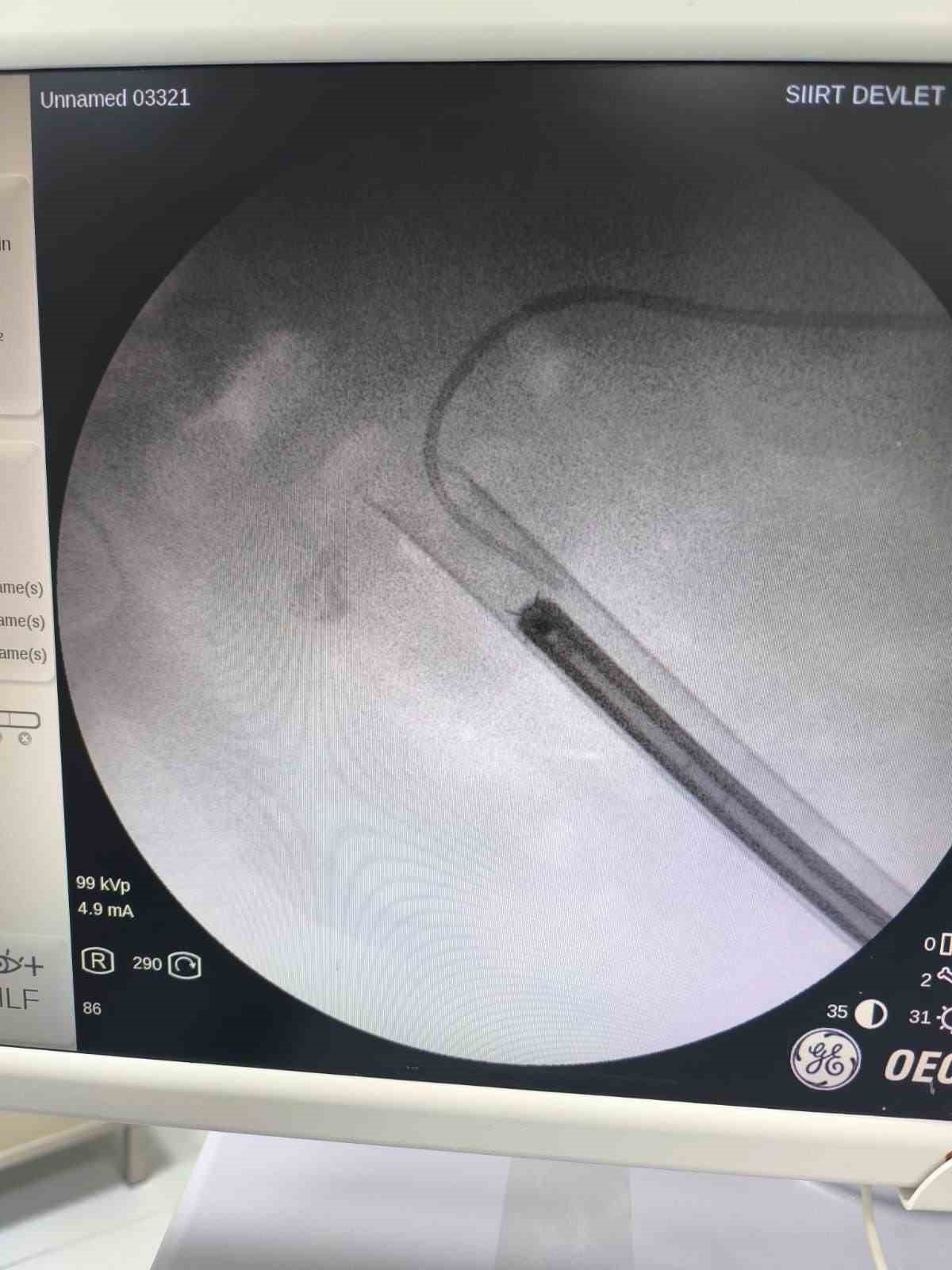 İdrar yanması şikayetiyle geldi geyik boynuzu taşı ameliyatı oldu
