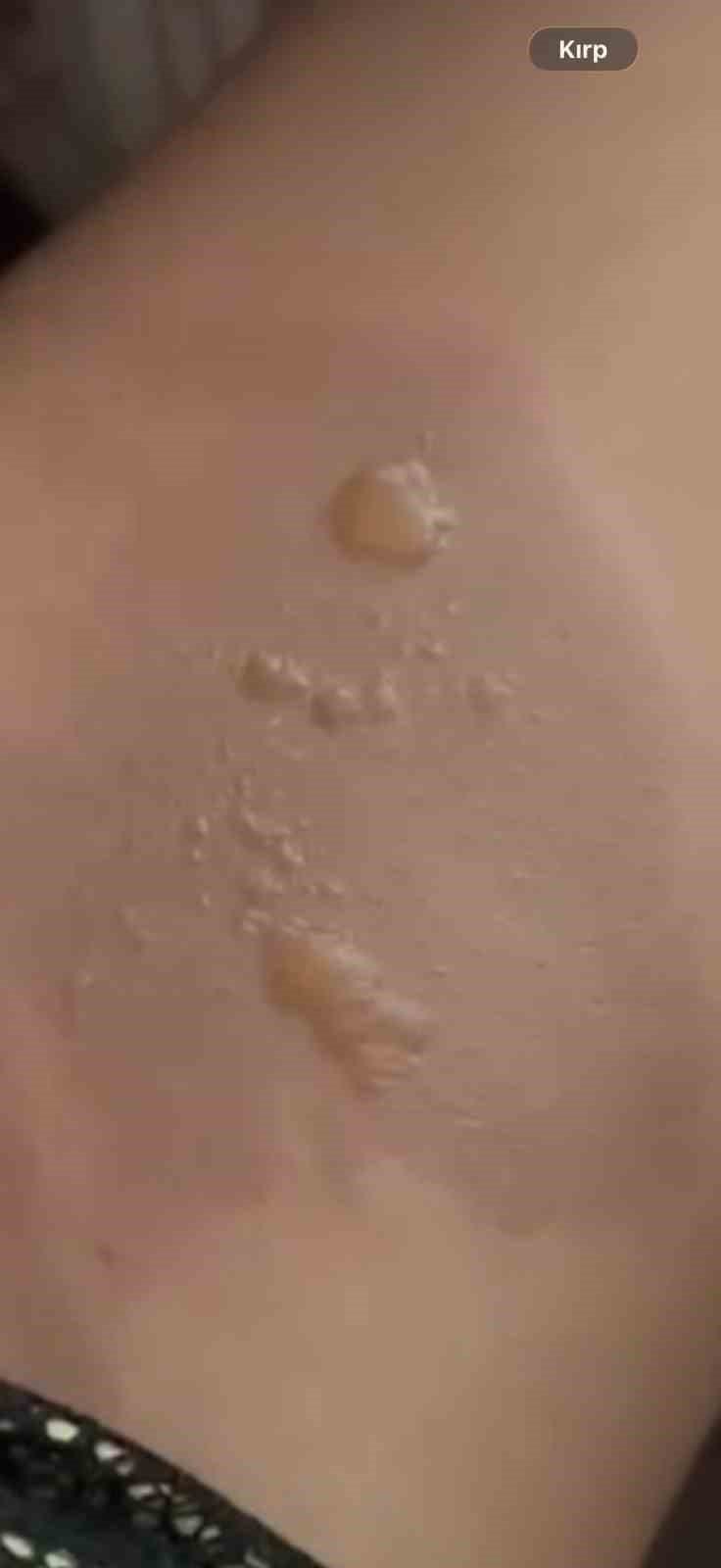 Yine sıcak su torbası yine facia: "Koyduktan 3 dakika sonra patladı"