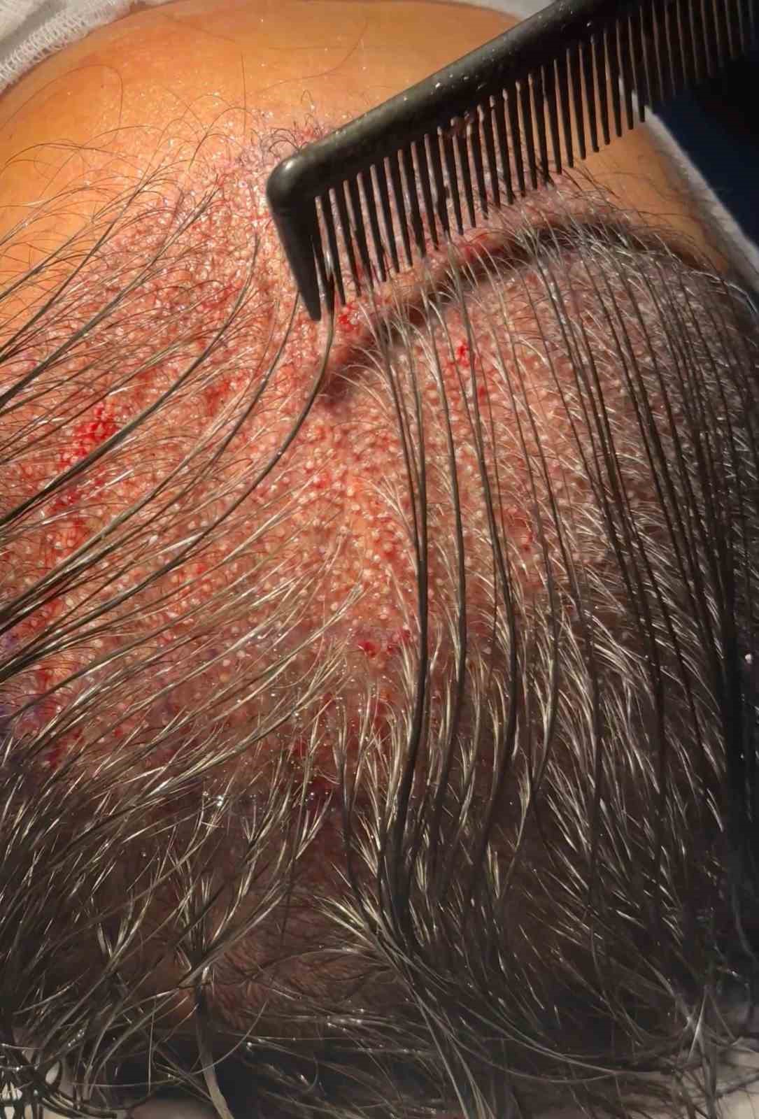 Kadınlarda tıraşsız saç ekimi mümkün: DHI tekniği öne çıkıyor