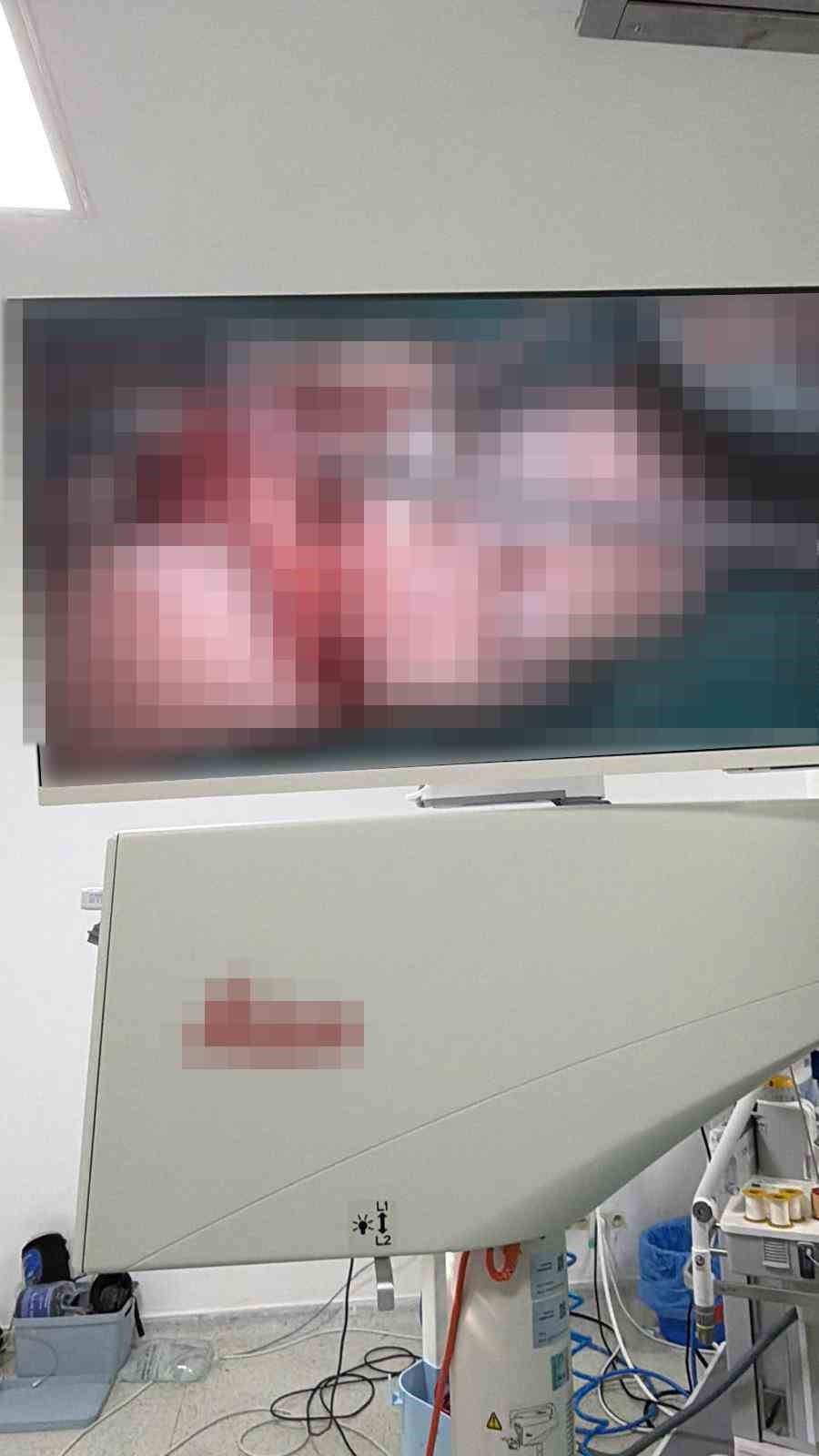 Bandırma&rsquo;da asans&ouml;r kazasında kopan parmak başarılı ameliyatla kurtarıldı
