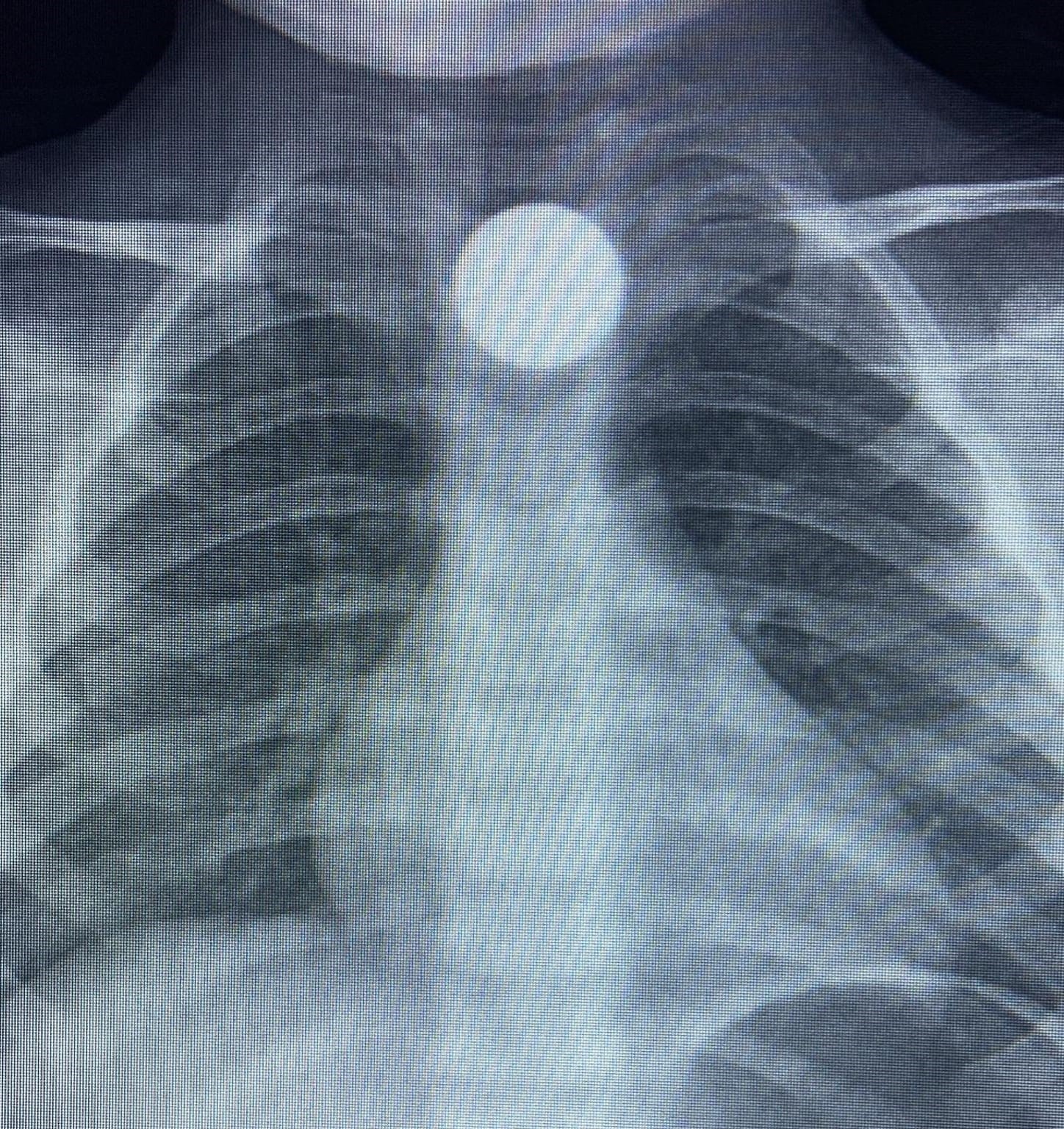 Bursa’da küçük çocuğun boğazına 50 kuruş kaçtı