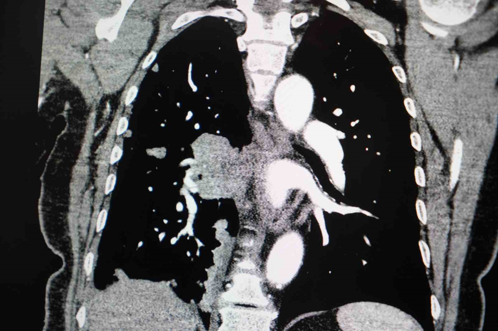 Profes&ouml;rden korkutan sigara a&ccedil;ıklaması: "Kadınlarda sigara kullanımı son 10 yılda y&uuml;zde 38 arttı"
