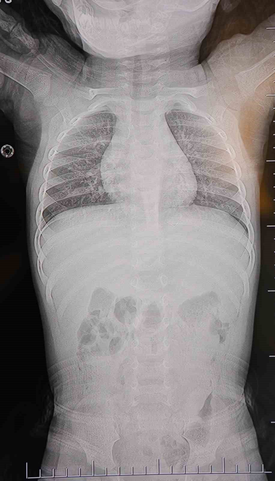 Kahramanmaraş’ta belinden zımba teli çıkan bebeğin ailesi sorumluların ceza almasını istedi