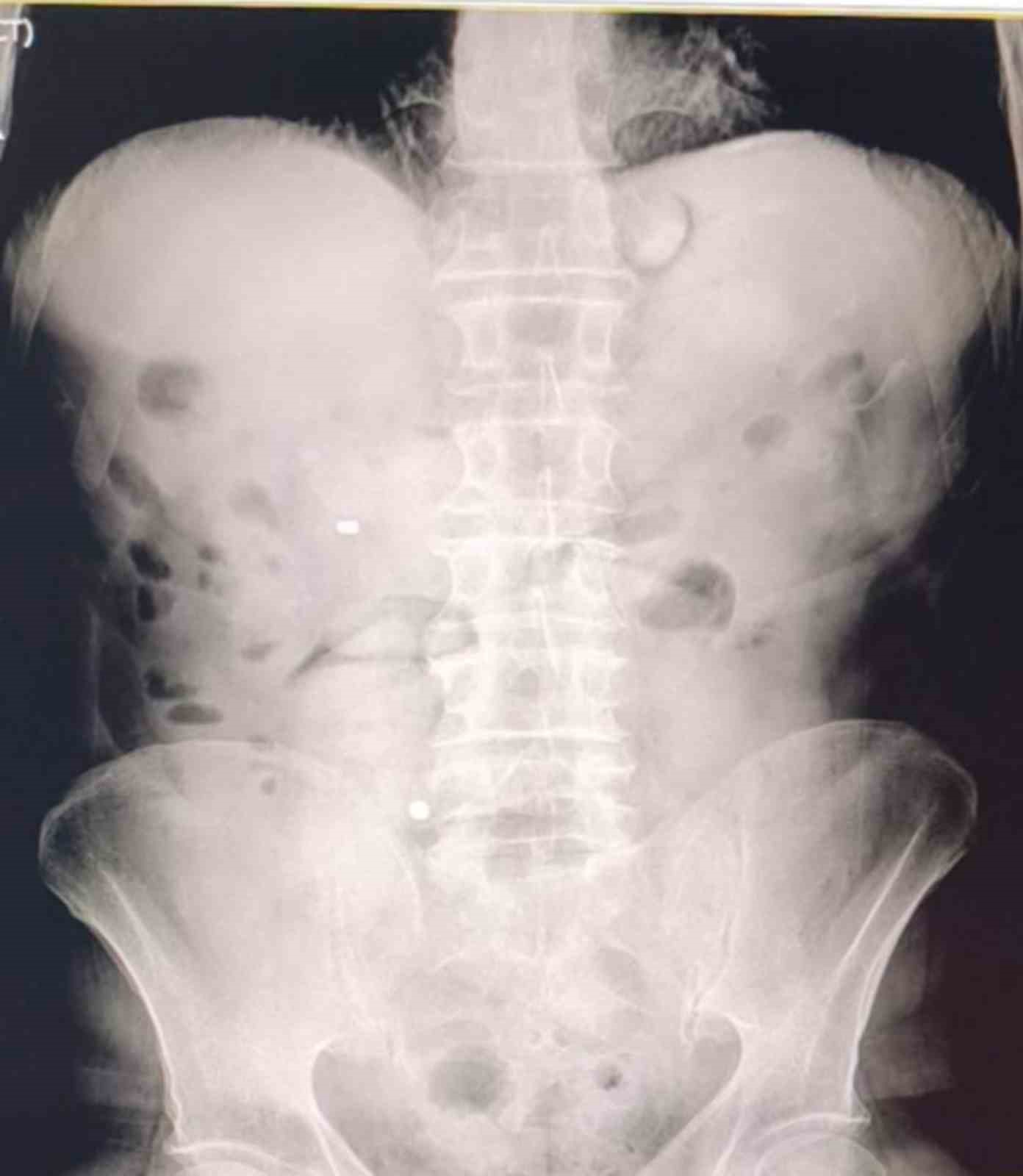 Midelerinden 1 kilo 70 gram metamfetamin &ccedil;ıktı
