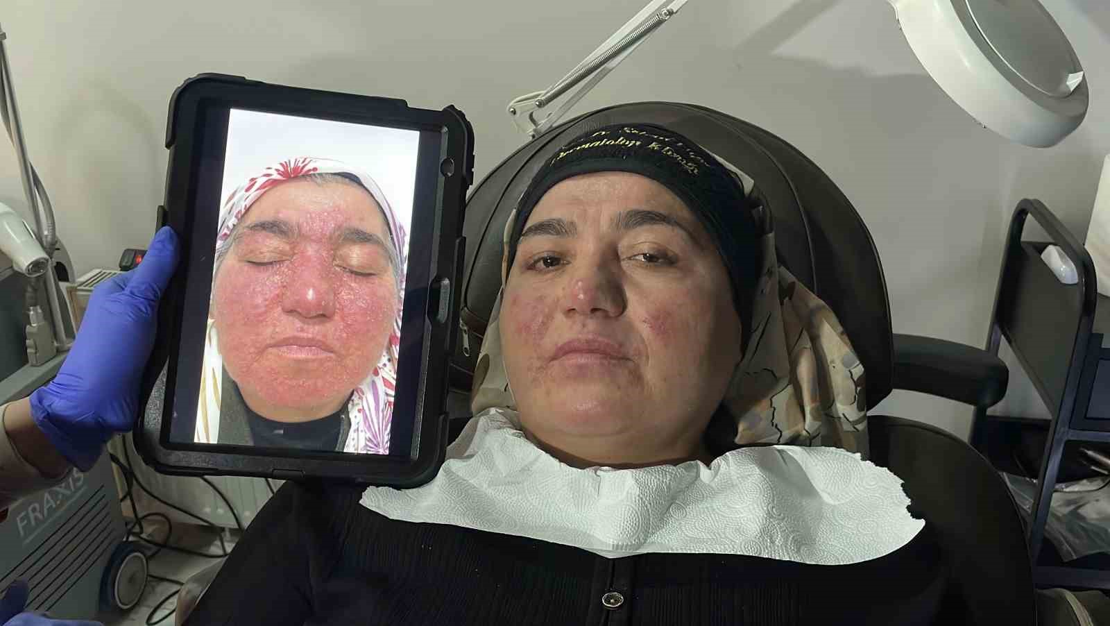 Hastalığı yüzünden yıllarca evden çıkamadı, şimdi ise çekinmeden çıkabiliyor