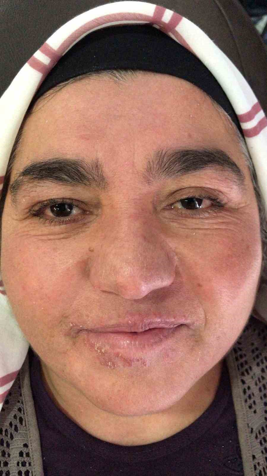 Hastalığı y&uuml;z&uuml;nden yıllarca evden &ccedil;ıkamadı, şimdi ise &ccedil;ekinmeden &ccedil;ıkabiliyor
