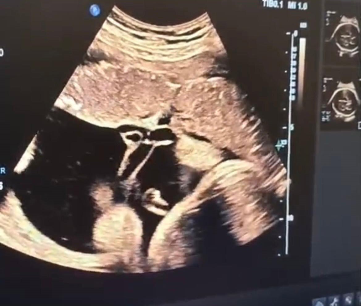 K&uuml;tahya Şehir Hastanesi&rsquo;nde anne karnındaki bebeğe kan nakli yapıldı
