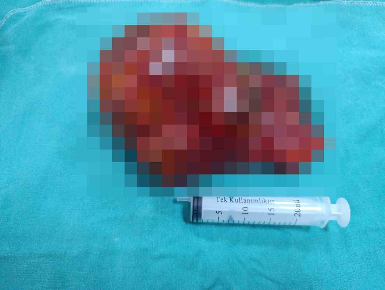 Malatya&rsquo;da 20 santimetrelik kitle kapalı y&ouml;ntemle &ccedil;ıkarıldı
