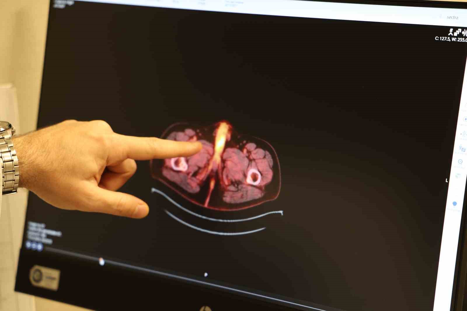 D&uuml;nyada şu ana kadar 60 kişide olan bu vakanın sonuncusu Diyarbakır&rsquo;da g&ouml;r&uuml;ld&uuml;
