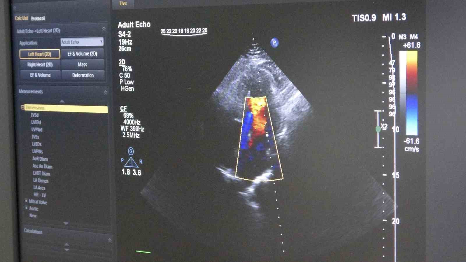 Ameliyatsız, stentsiz tedavi: Kalp damarları ila&ccedil; kaplı balonla a&ccedil;ıldı
